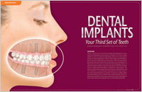 Article - Dental Implants - Your Third Set of Teeth