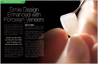 Article - Smile Design Enhanced with Porcelain Veneers