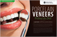 Article - Porcelain Veneers - Without A Drill