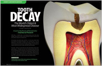 Article - What is Tooth Decay? - And How to Prevent It