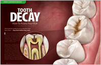 Article - Tooth Decay - How To Assess Your Risk