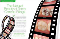 Article - The Natural Beauty of Tooth Colored Fillings