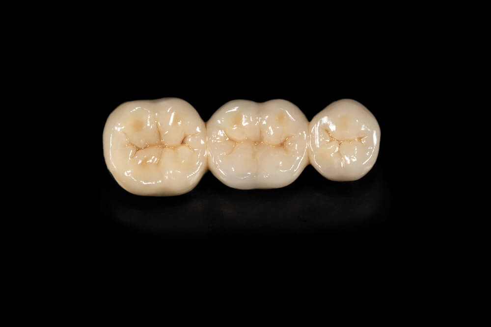 Ceramic tooth crowns and metal pin