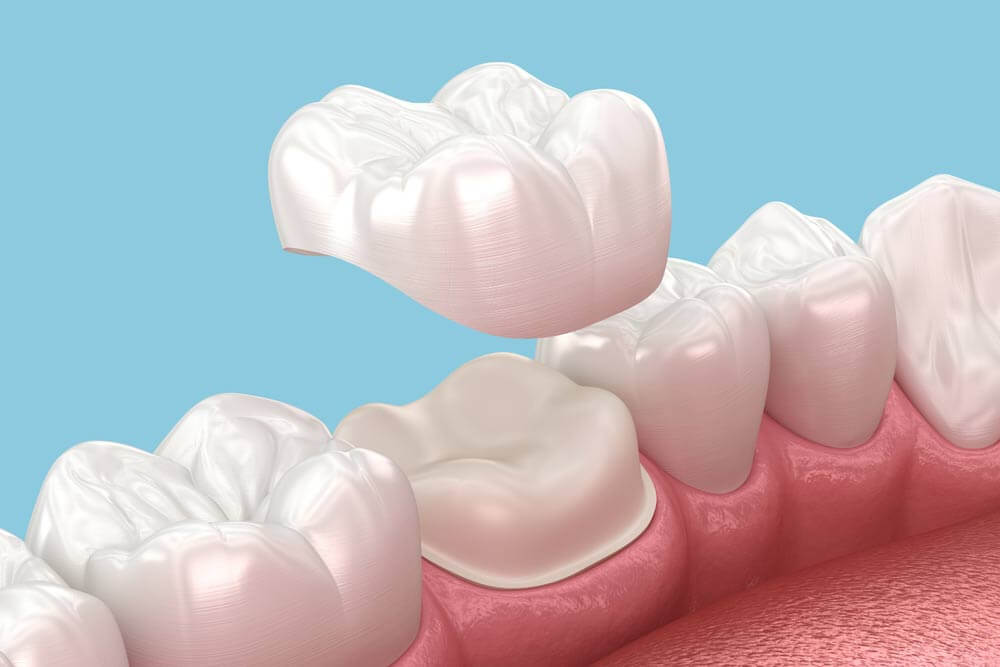 Dental crown placement over molar tooth. 3D illustration