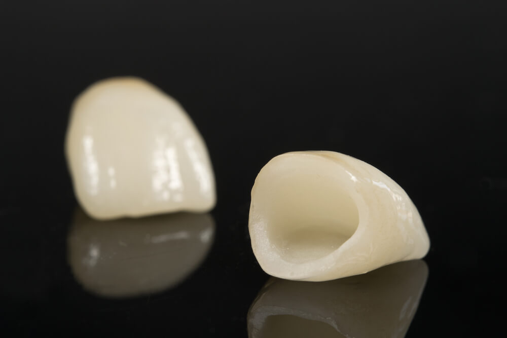 ceramic dental crowns