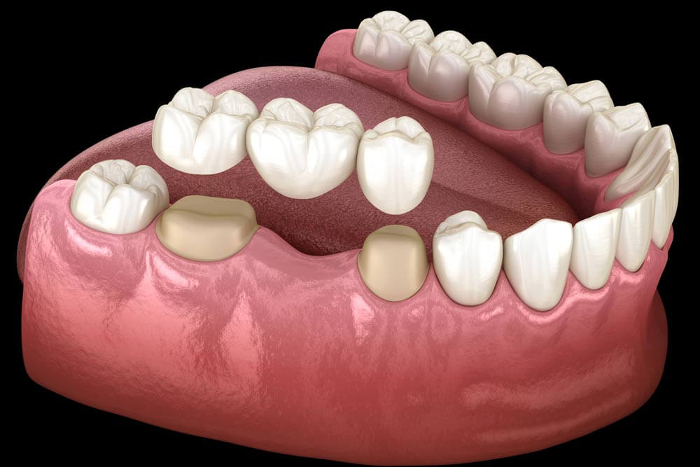 Preparated molar and premolar tooth