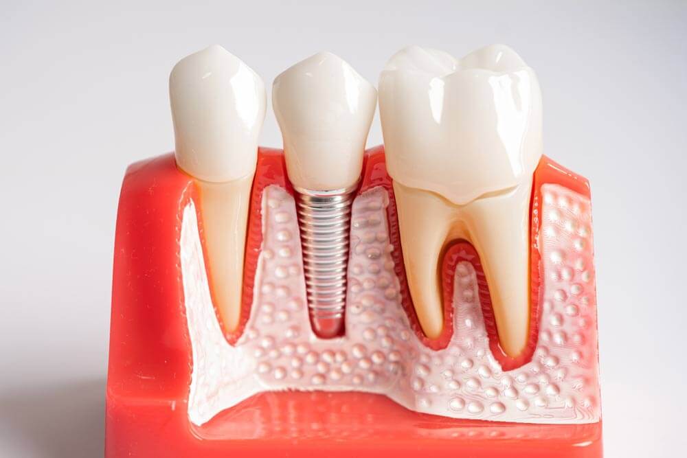 Dental implant, artificial tooth