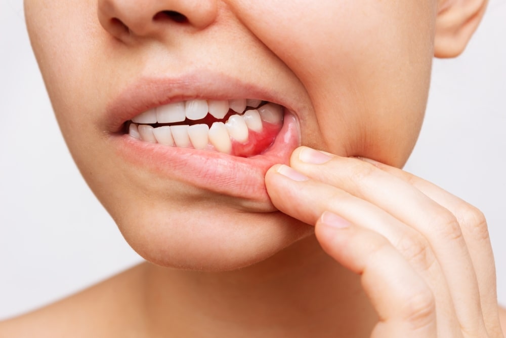 Woman showing red bleeding gums