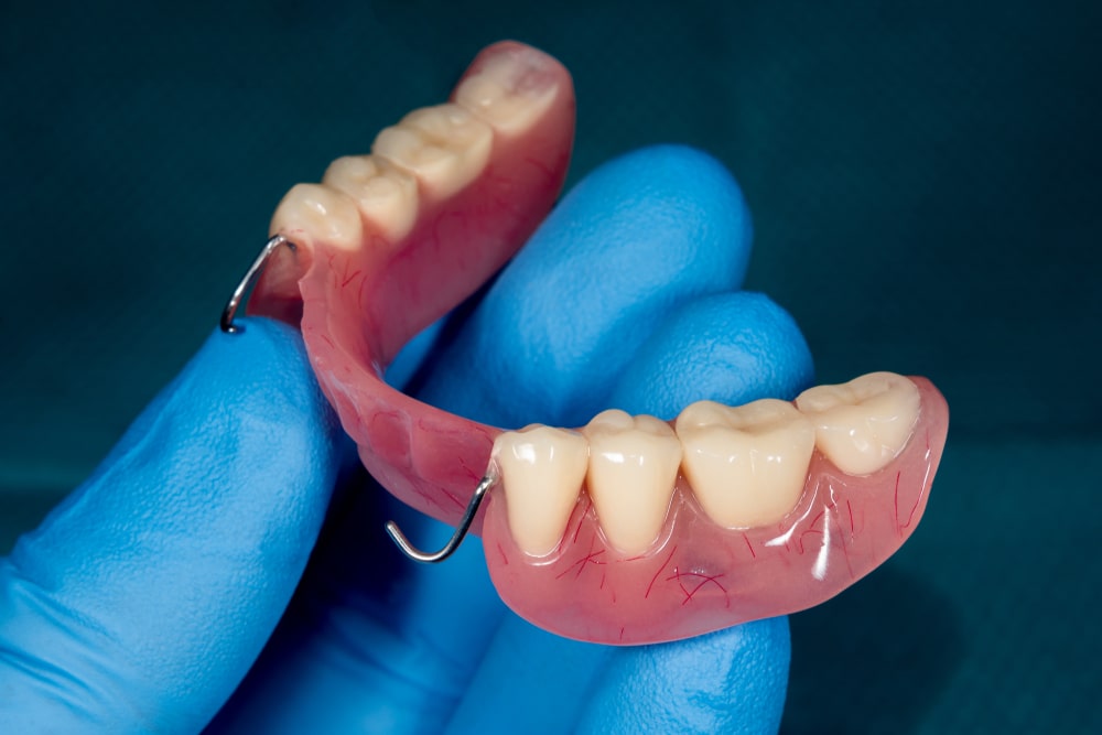 Partial removable denture of the lower jaw