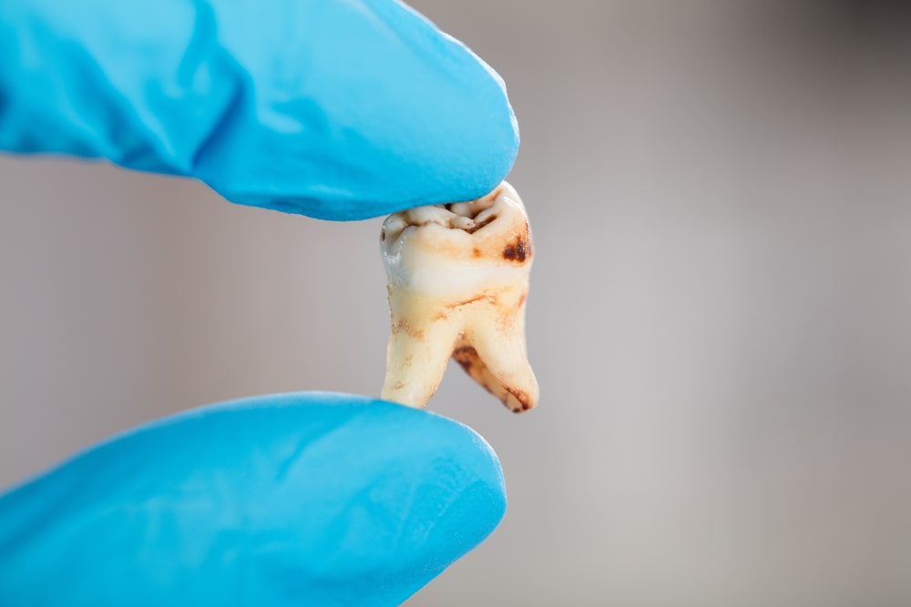 Close-up Of Dentist Hand In Glove Holding Decay Tooth