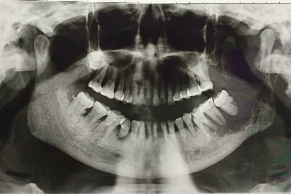 oral cancer show on X-ray film