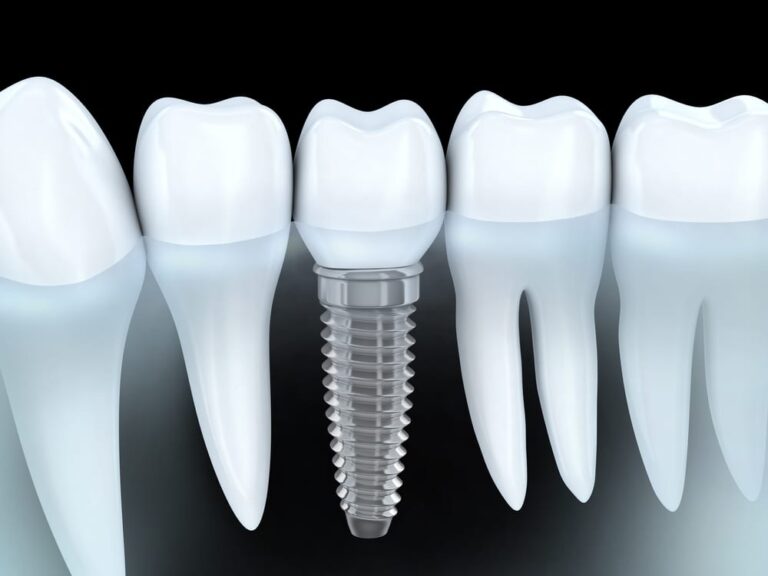 Premolar tooth recovery with implant
