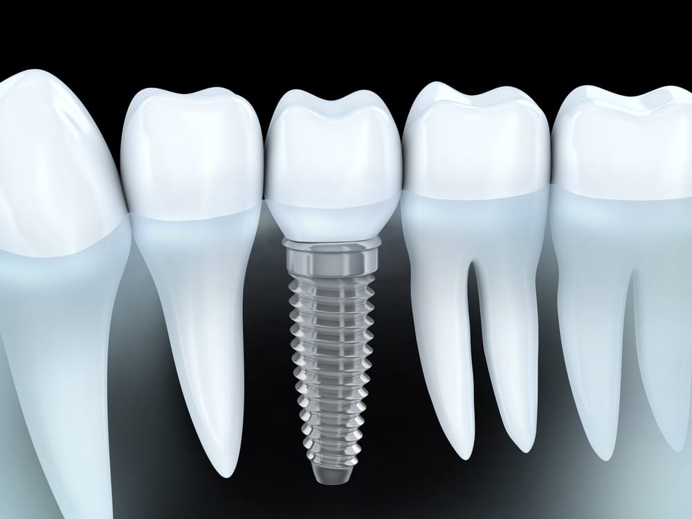 Premolar tooth recovery with implant