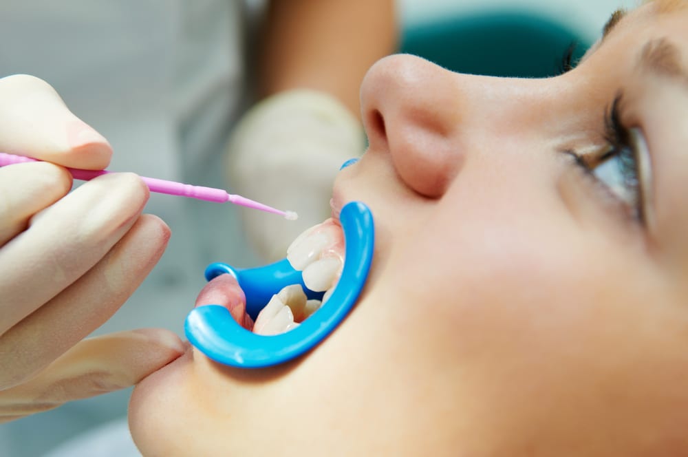 Woman with open mouth during dental procedure of teeth protective lacquer covering