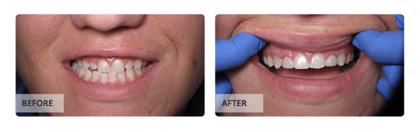 Before and after Cosmetic Bonding treatment
