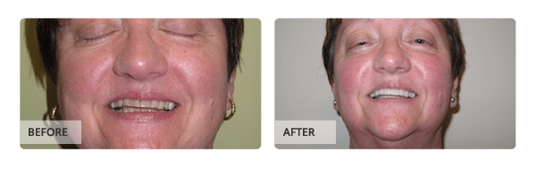 Before and after Veneers treatment