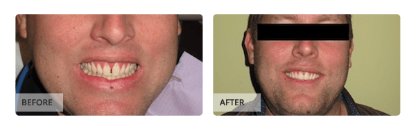 Before and after Veneers treatment