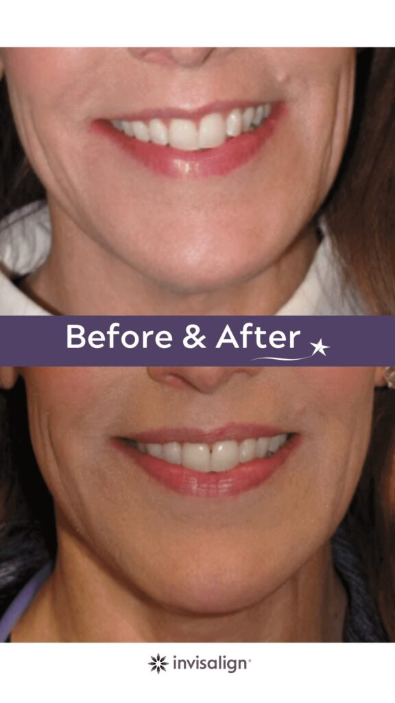Before and after Invisalign Treatment