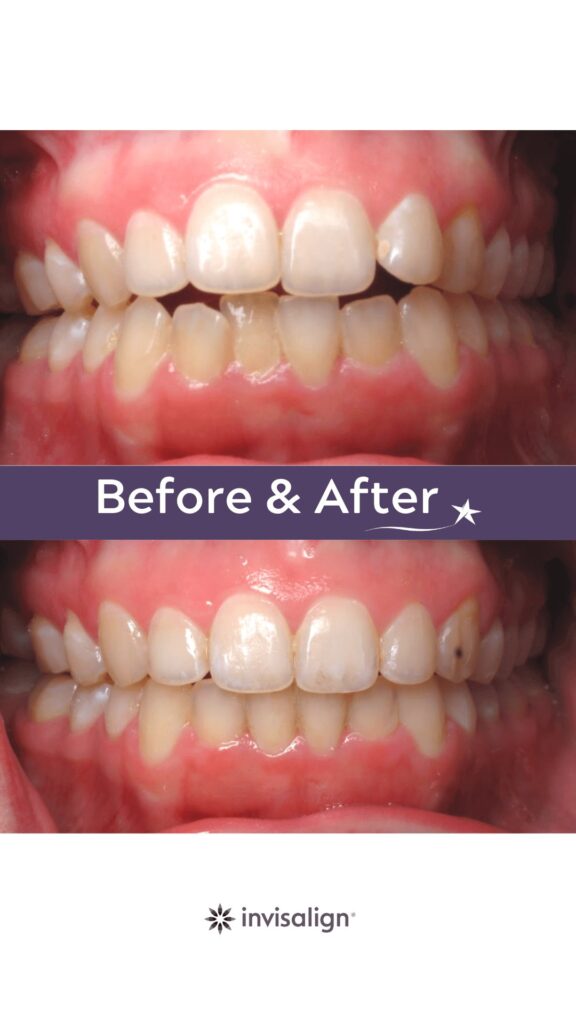 Before and after Invisalign Treatment