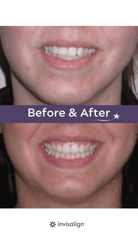 Before and after Invisalign Treatment