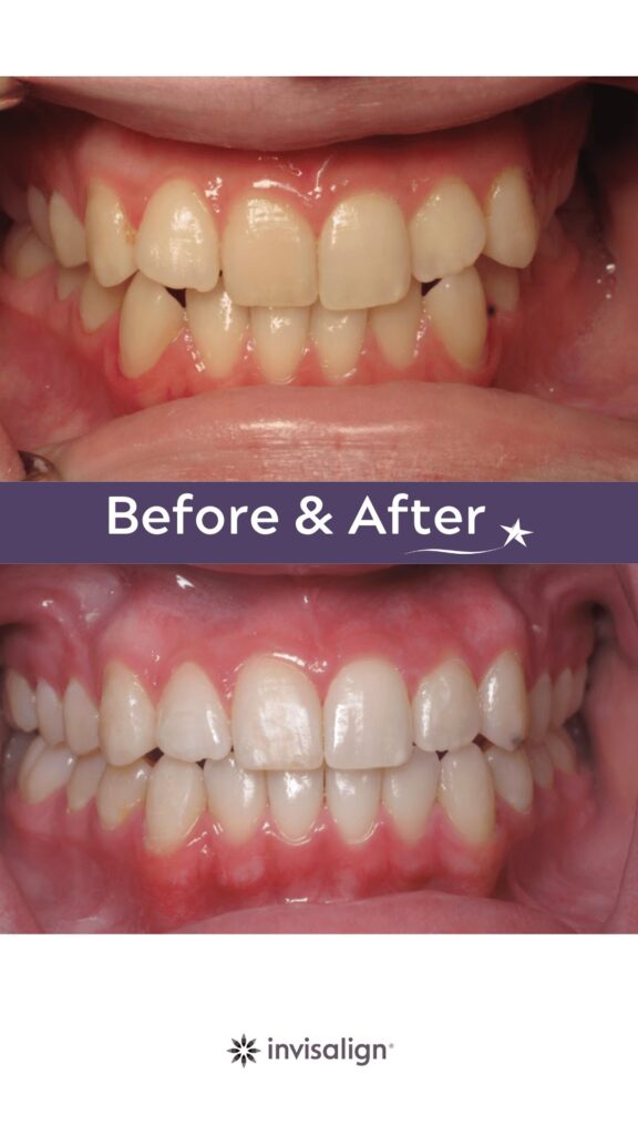Before and after Invisalign Treatment