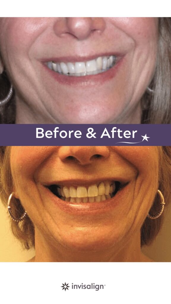 Before and after Invisalign Treatment