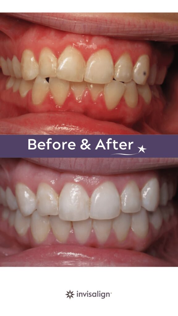 Before and after Invisalign Treatment