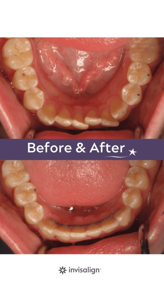 Before and after Invisalign Treatment