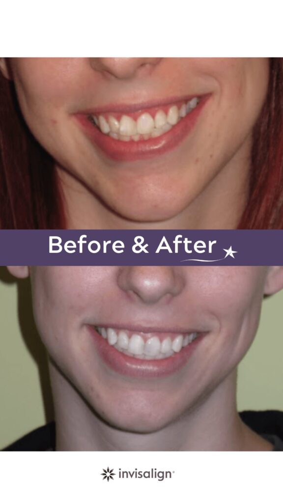 Before and after Invisalign Treatment