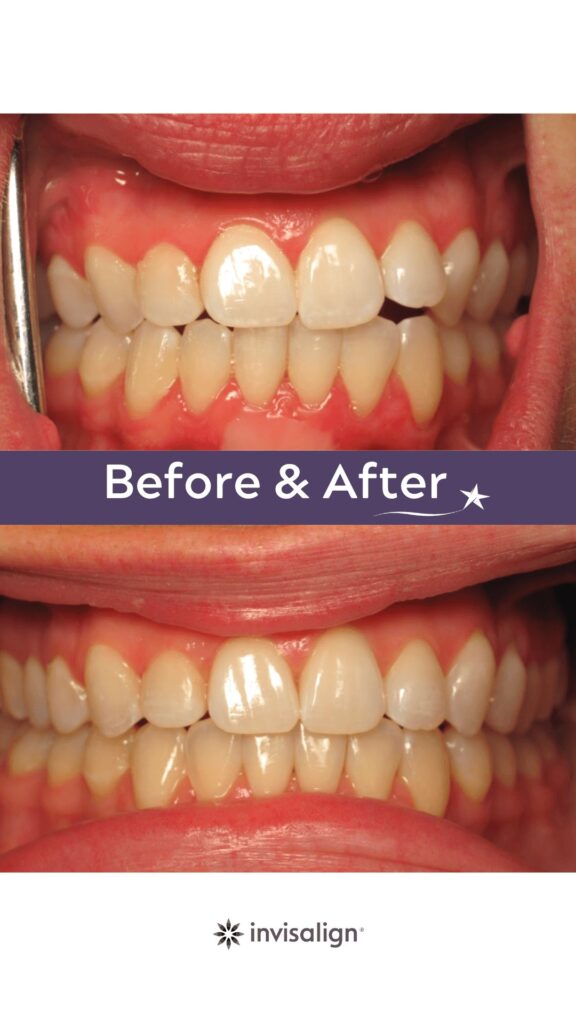 Before and after Invisalign Treatment