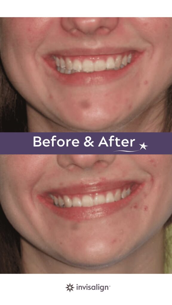 Before and after Invisalign Treatment