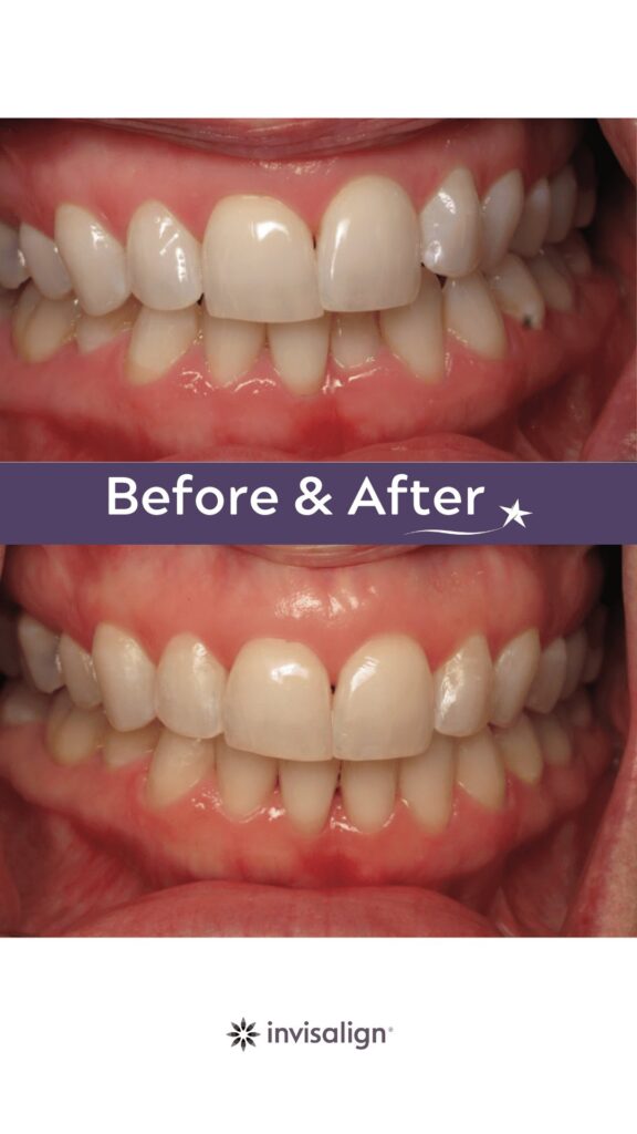 Before and after Invisalign Treatment