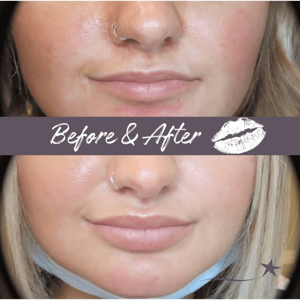 Before and after Botox & Fillers Treatment