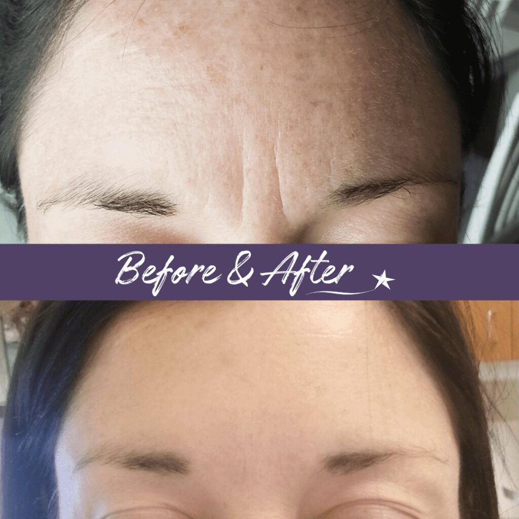 Before and after Botox & Fillers Treatment