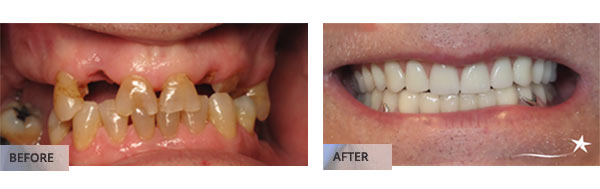 Before and after Crown & Bridge Treatment