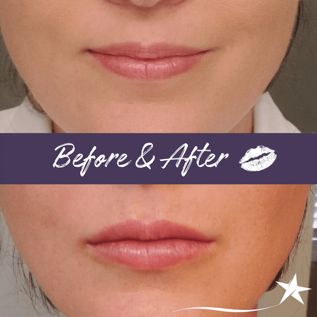 Before and after Botox & Fillers Treatment