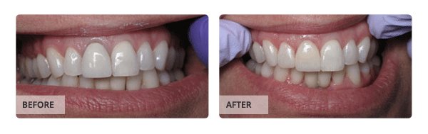 Before and after Crown & Bridge Treatment