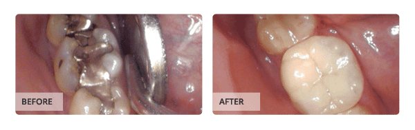 Before and after Crown & Bridge Treatment
