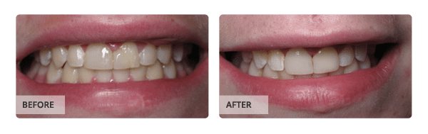 Before and after Crown & Bridge Treatment