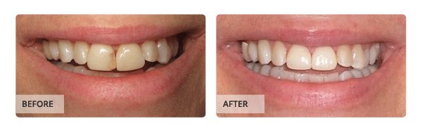 Before and after Crown & Bridge Treatment