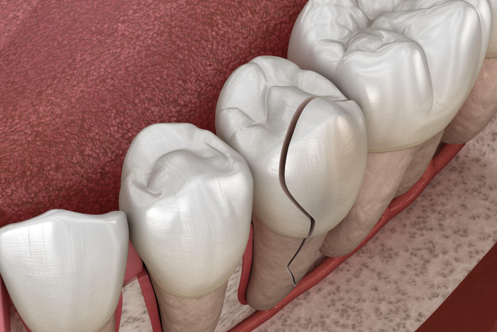 Cracked tooth, splitted. Medically accurate 3D illustration