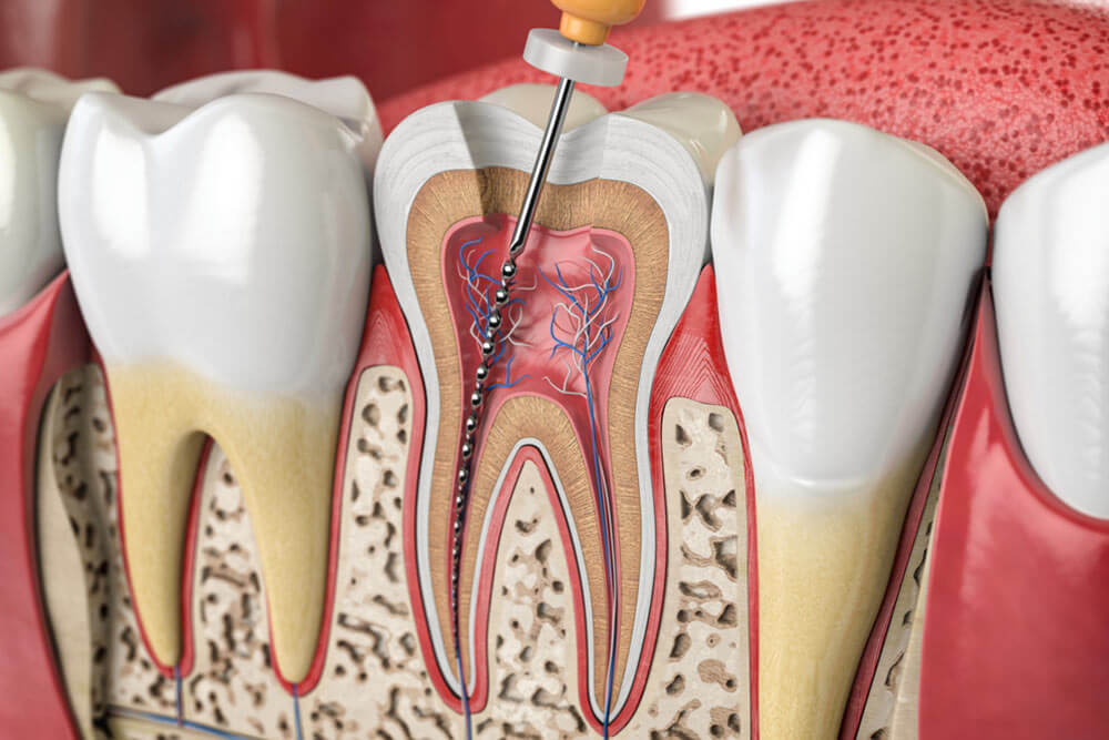 Cross section of human tooth with endodontic rotary file. 3d illustration