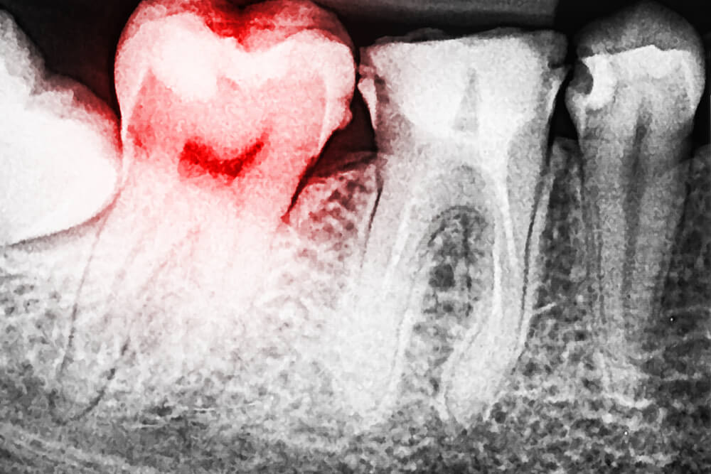 Pain Of Tooth Decay On Teeth X-Ray