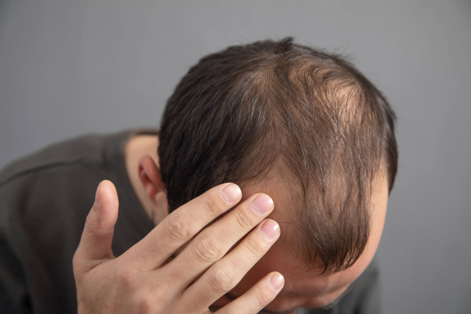 man with Hair loss problem