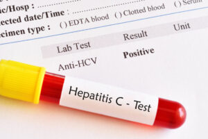 Hepatitis C virus positive test result with blood sample tube