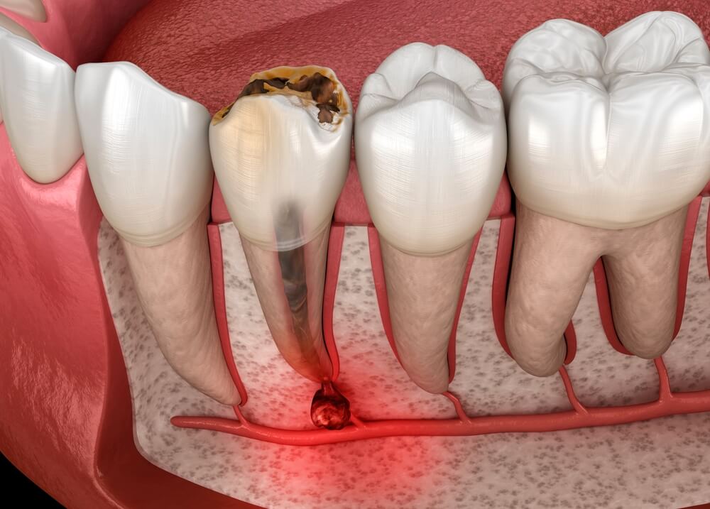 Lump on Gum Above Tooth