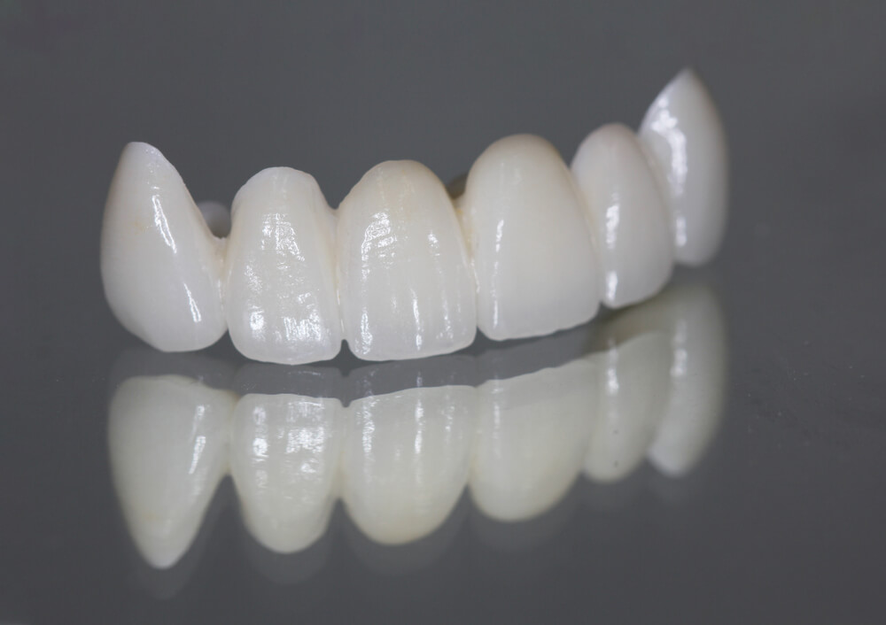 all-ceramic dental restorations