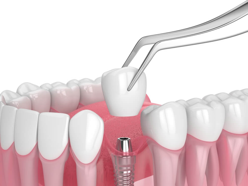 complex dental restorations