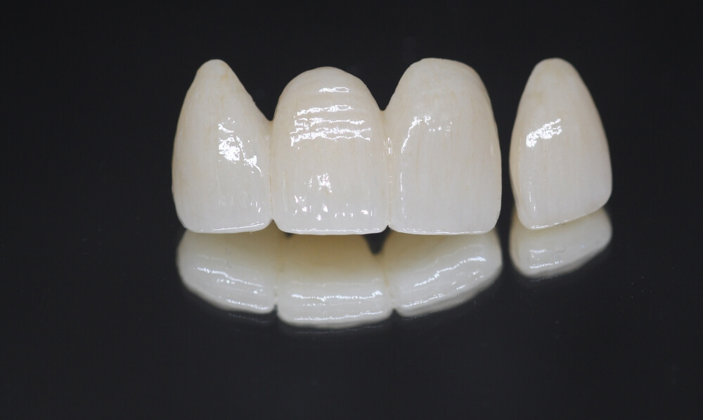 layered crown & bridge restorations