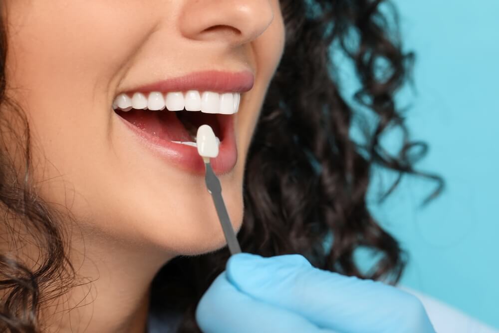 dental veneers